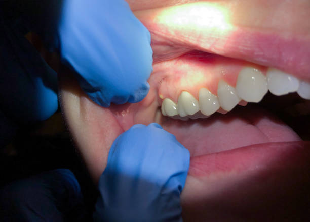 Best Root Canal Emergency Dentist  in Huntersville, NC